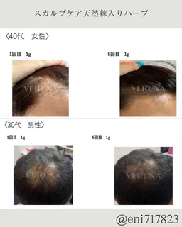 新店に向けた特別モニター4回💆‍♀️天然棘スカルプケア💆‍♂️生え際or1箇所｜ドライヘッドスパ含む贅沢施術4種類付