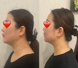 【新メニュー登場◆期間限定7980円】最上級7D H I F U ◆顔三層打ち10000shot