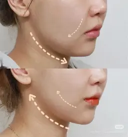 リフトアップ,フェイスライン、二重あご、ほうれい線改善!