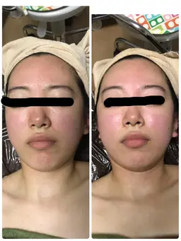 minimo限定✨口コミ＆写真撮影クーポン✨写真の目は消します😌