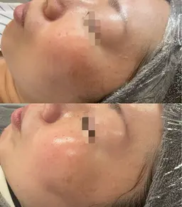 剥けない！即実感ハーブピーリング！