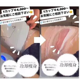 目標とする体型をお助け👯♀️《冷却痩身》1カップ¥4,000~