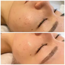 ご新規様限定!ドライヘッドマッサージ付《ハーブピーリング1g(¥5500円分)プレゼント》