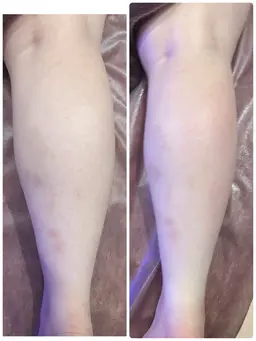 【痩身】ふくらはぎ　浮腫もスッキリ♪キャビテーション→ラジオ派→吸引EMS  施術時間30分