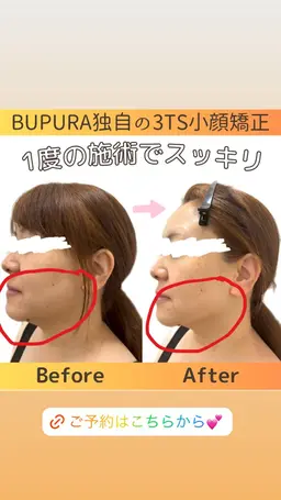 【徹底小顔＋毛穴洗浄♪】BUPURA式頭蓋骨小顔骨格矯正＋毛穴洗浄