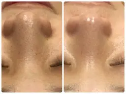 【新メニュー】気になる黒ずみ毛穴に！ハイドラフェイシャル！美容液で毛穴を洗い流しピーリング→毛穴レスピカピカな艶肌へ✨