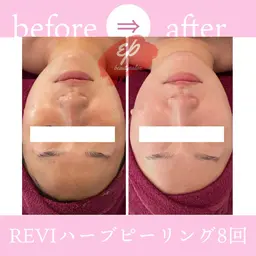 REVIハーブピーリング🌿くすみ改善・透明感のあるお肌に♪※カウンセリングは無料。施術体験される方は¥8,800