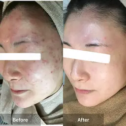 🌿肌質改善ハーブピーリング✨【剥離あり】【美容液】ニキビ/ニキビ跡/黒ずみ/水光肌 /白ニキビ /毛孔性苔癬/毛穴