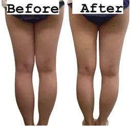 冷凍痩身20カップ‼️✨