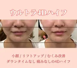 【何度でも同価格】小顔はいふ❤️‍🔥切らない小顔･リフトアップ 3層打ち✨全顔