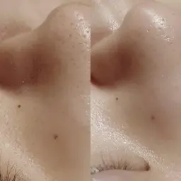 毛穴洗浄エステ🌪️【水素水で毛穴洗浄吸引+美白モイストマスク】毛穴ケア