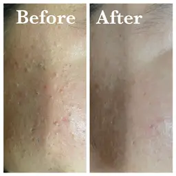 平日限定⭐️ピーリング毛穴エステ💆♂️