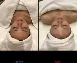 毛穴詰まりに◎【ララピーリング】韓国で話題のピーリング！全顔の施術(+¥500で首も可能)