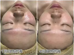 剥けないハーブピーリング🌿ダウンタイム無し！施術後直ぐに化粧OK🙆‍♀️
