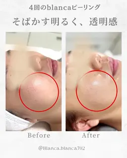 肌管理✨水光肌ピーリング(エクスビアンス)。デコルテマッサージ15分