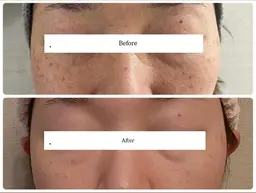 【−5歳見え✨】ほうれい線・たるみ引き上げフェイシャル⤴️