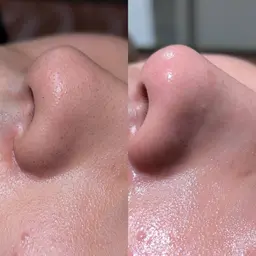 【ミニモ限定価格🉐】毛穴洗浄🫧＋美白炭酸パック