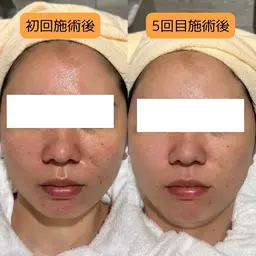 【人気No.１】お悩み別集中フェイシャルフルコース🫧¥5,500（税込）｜約75分