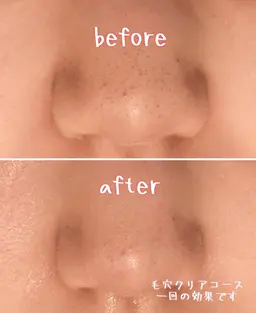 毛穴クリアコース