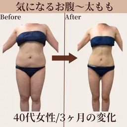 【中胴体☆痩身】着たい服を着こなす♪スッキリボディライン◎悩み深いお腹/お尻/太もも/前ハリに★《初回限定💫特別価格》
