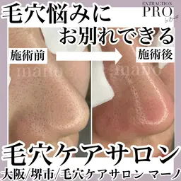 毛穴デコルテコース(毛穴エクストラクションプロあり)