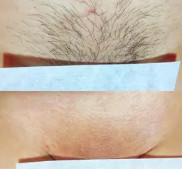 女性限定チクチク、ザラザラとおさらば🌬️ツルスベVIO🍯オールオフ