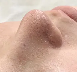 50%OFF✨毛穴ディープクレンジング&収れんケア（カウンセリング30分＋施術60分）