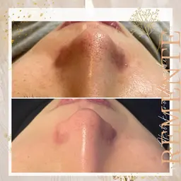 【ハイドラフェイシャル】毛穴の汚れ洗浄で角質除去✨ニキビ肌や黒ずみ改善に効果❣️