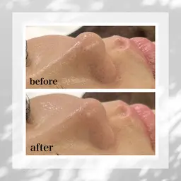 1日1名【いちご鼻/黒ずみから卒業したい方限定】Tゾーン毛穴洗浄お試し30分