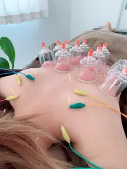 【辛い頭痛に😮‍💨】首肩鍼灸✖️カッピング！