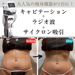 【半身90分】痩身歴14年が担当！キャビテーション＋ラジオ派＋吸引🔥※生理中NG /人気クーポンの為事前予約オススメ！