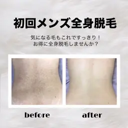 👨🏻初回メンズ脱毛👨🏻全身脱毛(顔、VIO含まない)🍀特別価格🍀