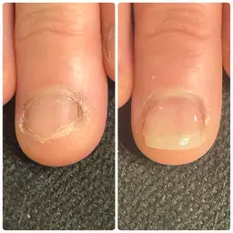 即日美爪形成コース　　　　　　　　　　　　　　　　　　　たった3時間で変わる深爪矯正