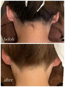 UPにも自信を☆うなじ光脱毛