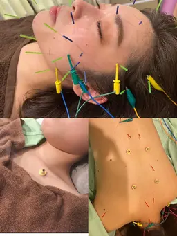 80分【全身鍼＋3Dリフト美容鍼】✨全身の血流を良くして、お顔のくすみ、むくみを取り除きリフトアップ　マッサージ付き