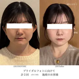 【ブライダルに向けた定着】miélu式小顔 90min