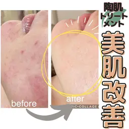 【ニキビケア✧ハーブピーリング】剥離なしハーブ＋シルクの導入美容🌿ニキビ・赤み・乾燥