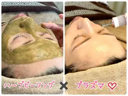 【平日限定✨初めての方20%オフ✨毛穴や頑固なニキビ肌に】剥離なしハーブピーリング🌿とプラズマの贅沢コース💖