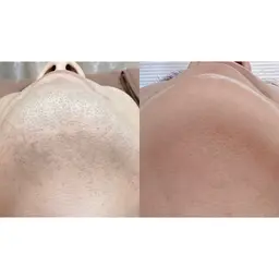 【メンズ限定】ヒゲ脱毛初回体験¥2,200