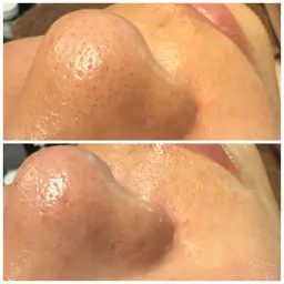 【毛穴ケア】毛穴や角質のザラつき気になる方におすすめ◎