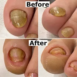 【急募】セミナー無料モデル募集❣️巻き爪、変形・肥厚爪、うおの目、タコでお悩みの方🦶メニュー詳細をご覧ください😊