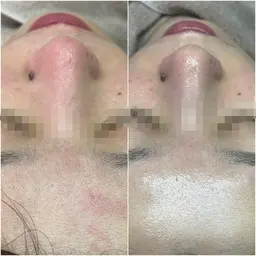 3 /6限定❤️特別体験✨ハーブピーリング➕鎮静保湿パック