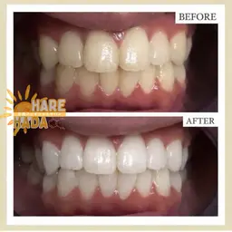 🎀短時間で白さ実感✨🦷30分照射セルフホワイトニング