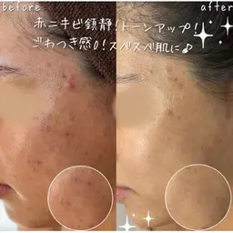 【ミニモ限定特別価格‼︎】話題のハーブピーリン＋ピーリング力UP⤴︎のエンザイム0.5g付き✨ニキビ、毛穴ケアに◎