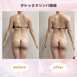 【リラックスもダイエットも◎】全身デトックスリンパ&最新ラジオ波×2回✨深部温活×リンパでスッキリボディへ💪🏻