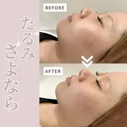 まるで糸リフト級のリフトアップ‼️『chulaリフト』