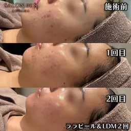 ♡韓国肌管理ララピール×水玉LDM♡どこよりも結果の出る根本改善体験❕つるん肌＆毛穴レス🫧韓国美肌管理の新常識♡