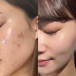 【初回20%OFF】グリーンピール5daysアフタートリートメント込