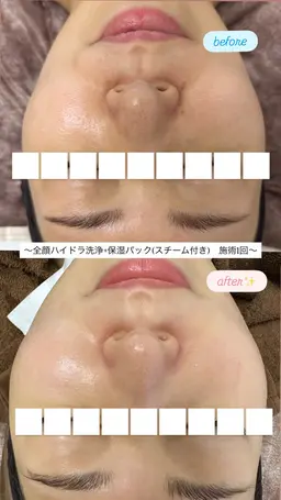 【ご新規様】全顔ハイドラ毛穴洗浄+保湿パック✨(40種類以上の美容液・スチーマー使用🪄)