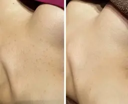 ハーブピーリング🌿デコルテ